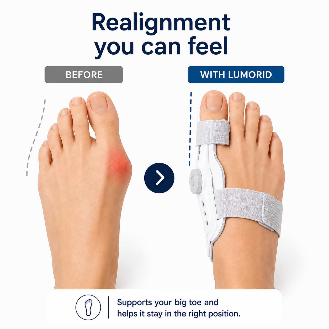 Bunion Corrector